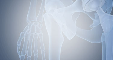 O que é artroplastia do quadril?