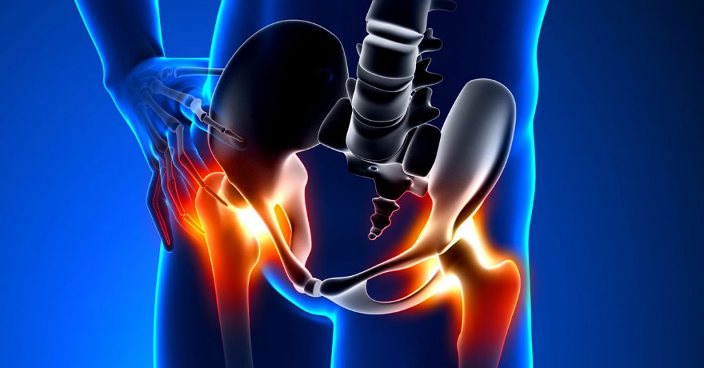 Quais as diferenças entre artrite e artrose no quadril?