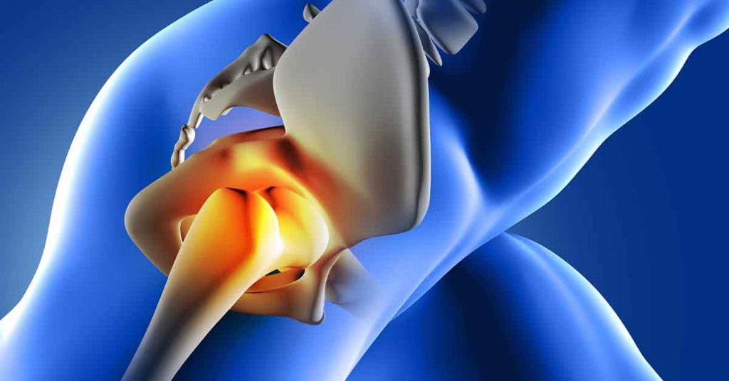 Artroscopia do Quadril: Solução Minimamente Invasiva para Atletas